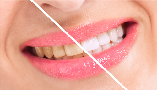 tooth whitening